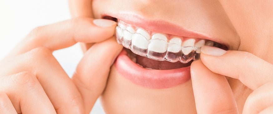 invisalign_OdgNeS7.jpg.874x364_q85_box-0,250,2213,1170_crop_detail