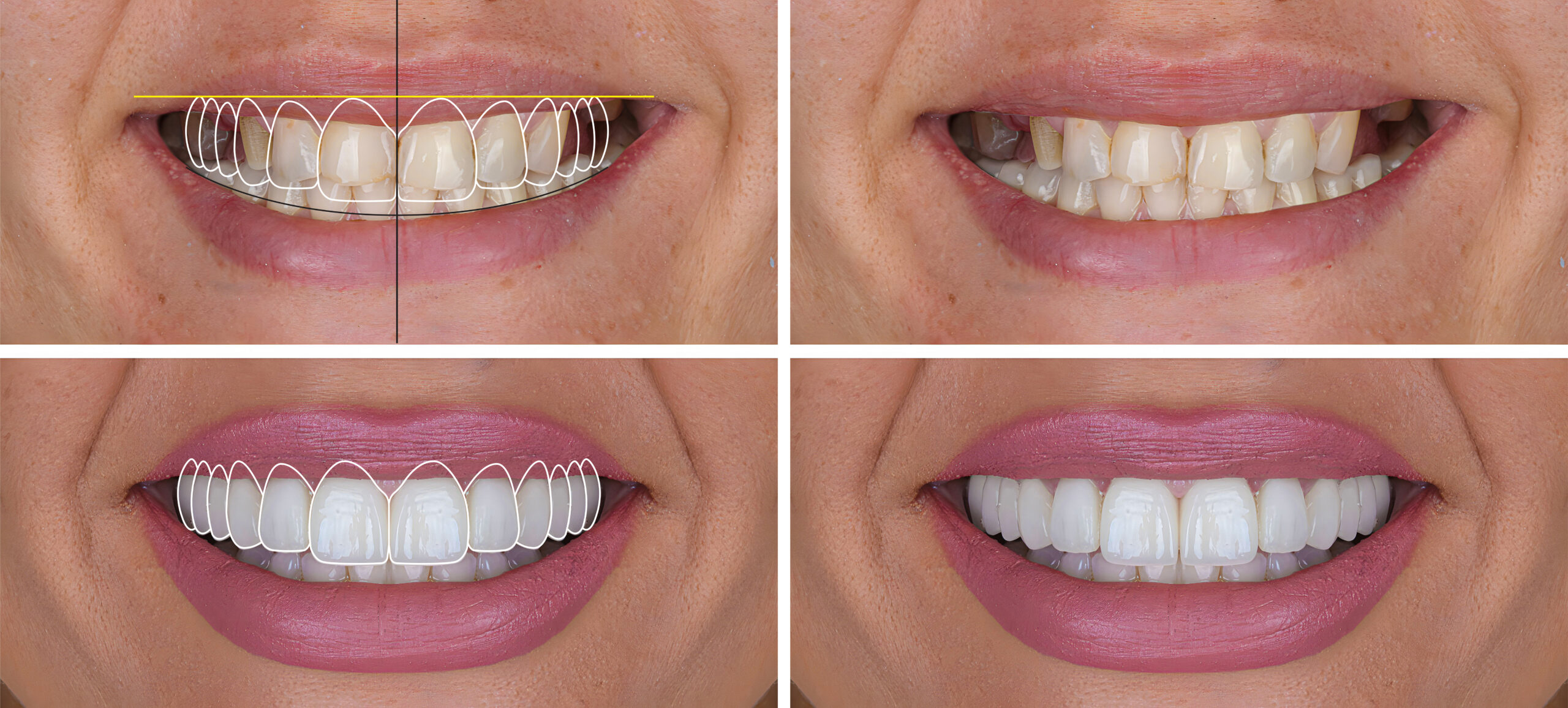 Cosmetic dentistry and custom smile design at Smile Center