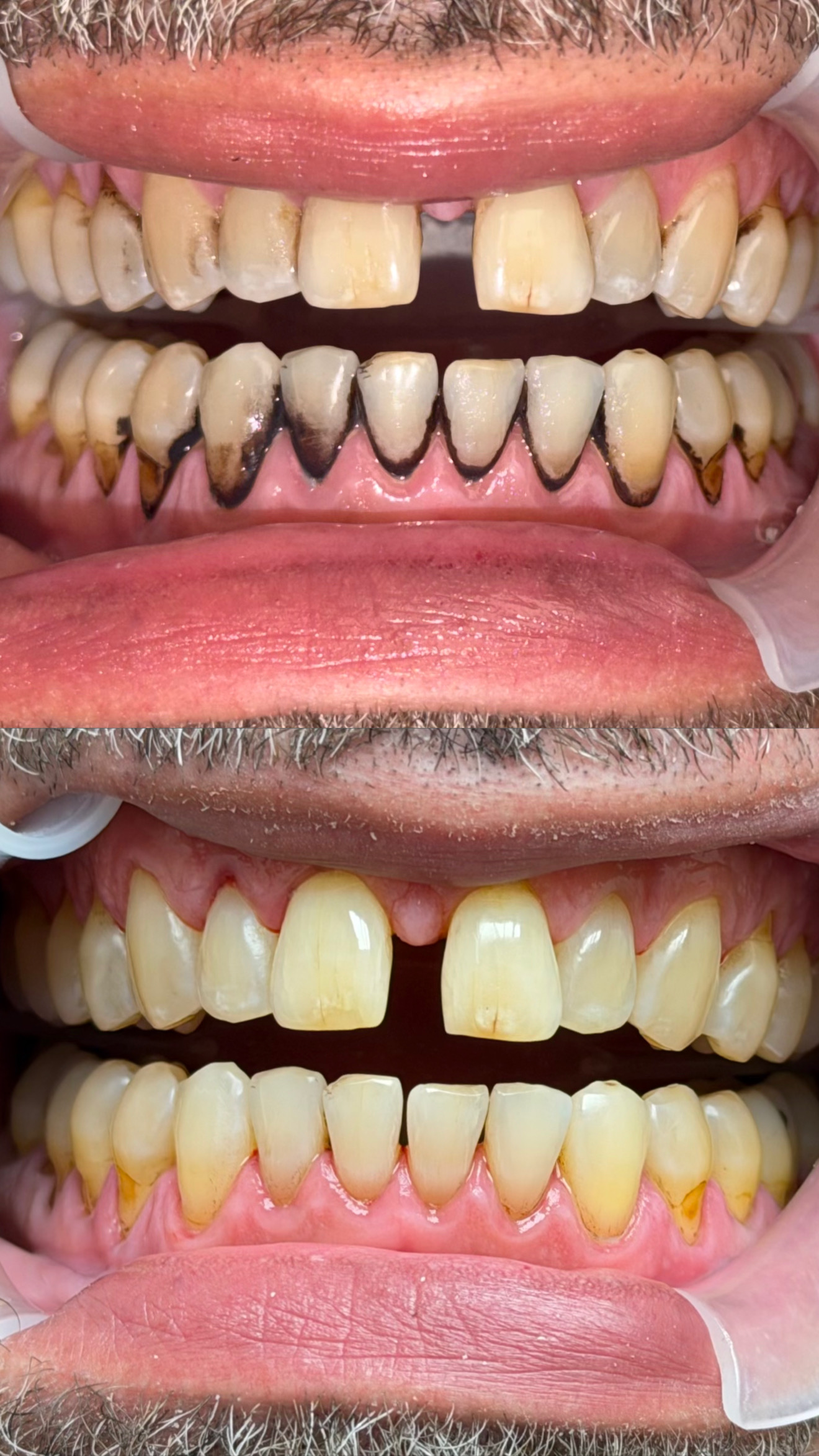Dental stain removal