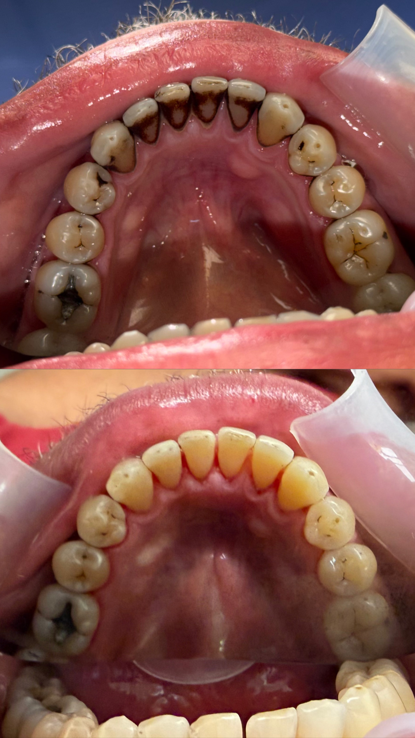 Professional dental cleaning