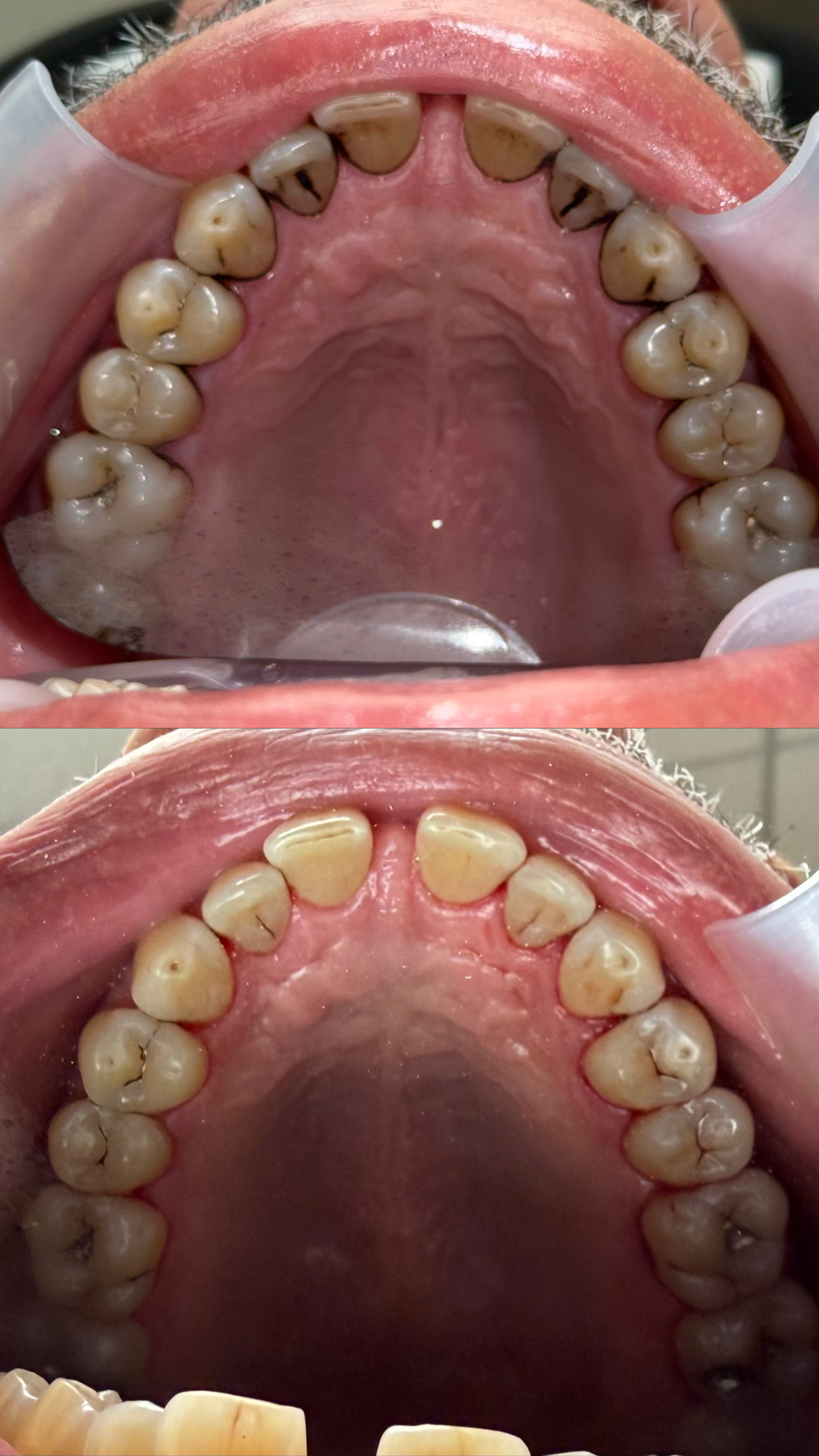 Teeth stain removal