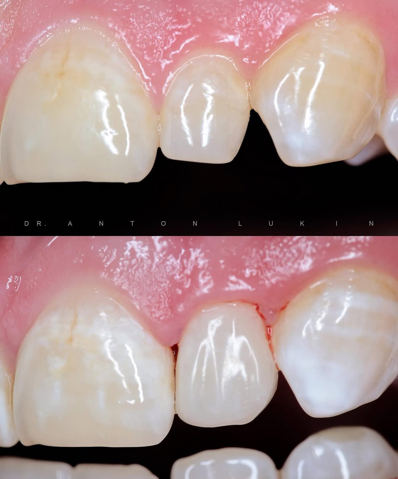 Smile Center veneer before and after