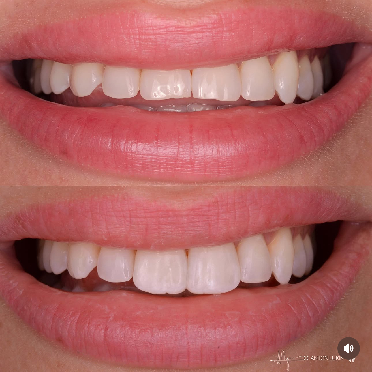 Smile Center cosmetic dentistry result