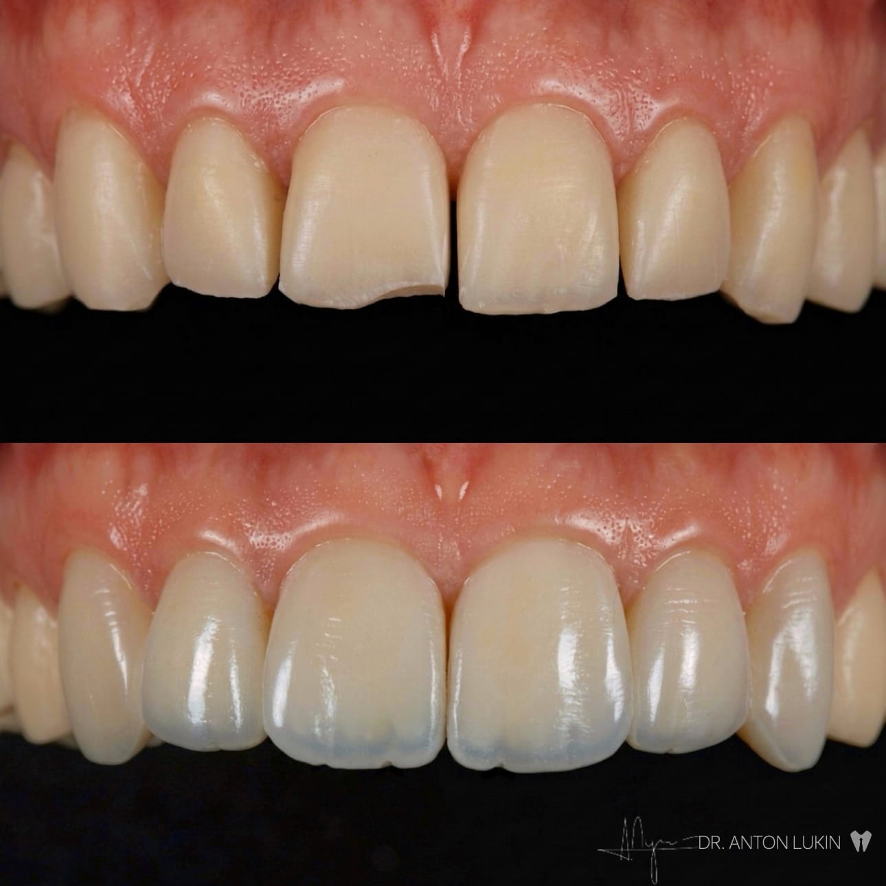 Smile Center veneer transformation