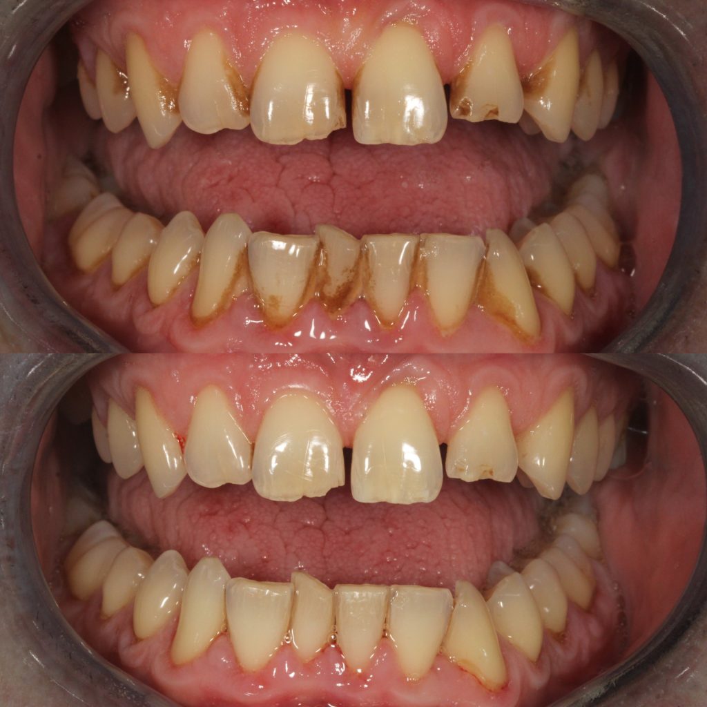 AirFlow stain removal before and after
