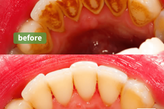 airflow-stain-removal-treatment-before-and-after-3